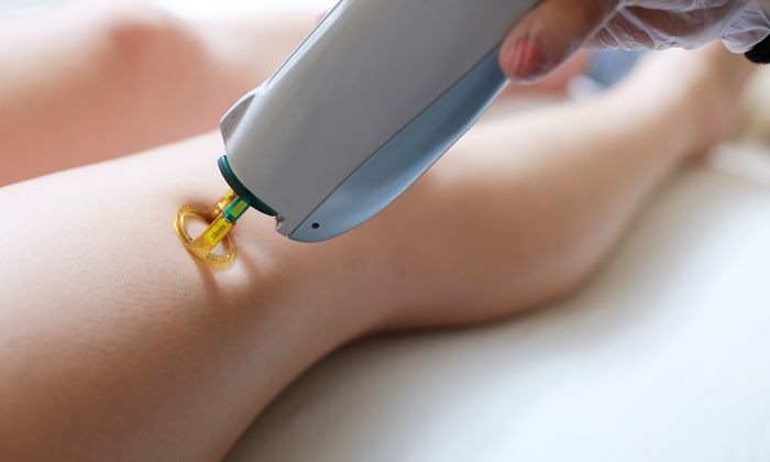 Facts To Understand Concerning The Laser Hair Removal
