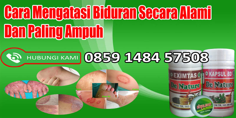 Cara Mengatasi Biduran Secara Alami Dan Paling Ampuh