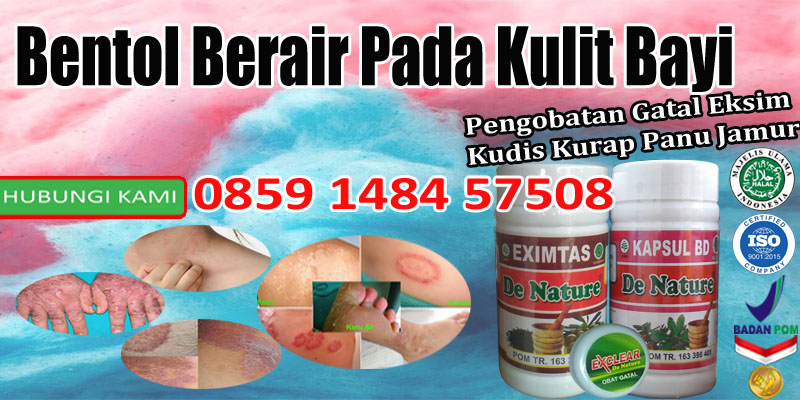 Bentol Berair Pada Kulit Bayi - Detik Kesehatan