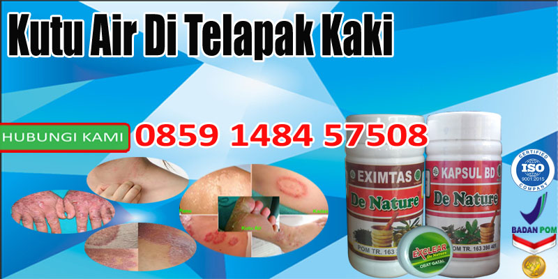 Cara Mengatasi Kutu Air Di Telapak Kaki