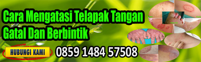 Cara Mengatasi Telapak Tangan Gatal Dan Berbintik