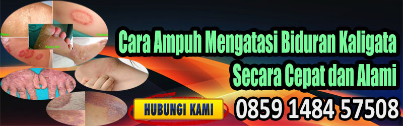 Cara Ampuh Mengatasi Biduran Kaligata Secara Cepat dan Alami