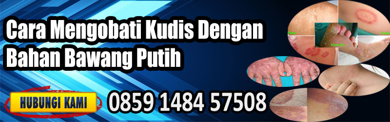 Cara Mengobati Kudis Dengan Bahan Bawang Putih
